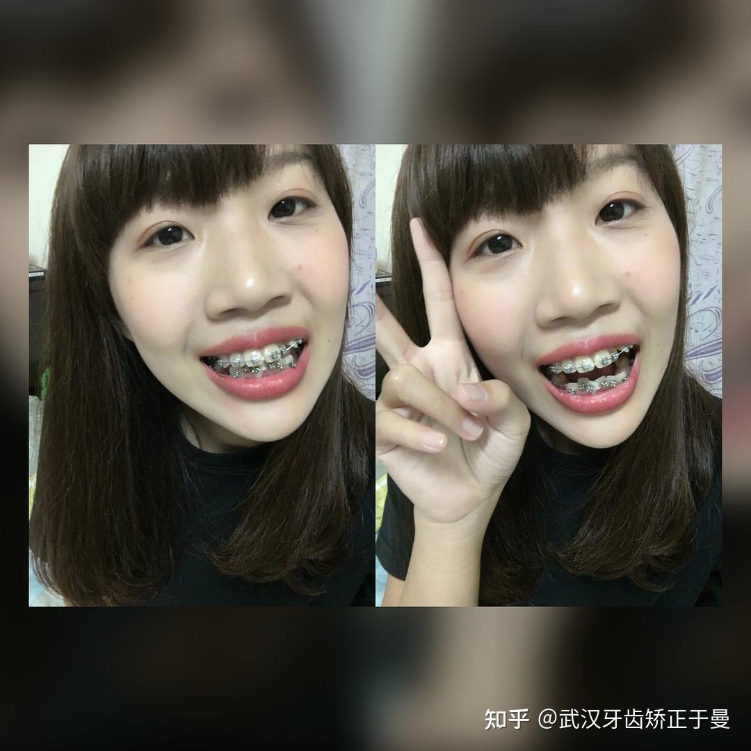 戴着牙套也敢笑啦~这可是我的"财富"露出牙套其实觉得也很可爱~戴牙套