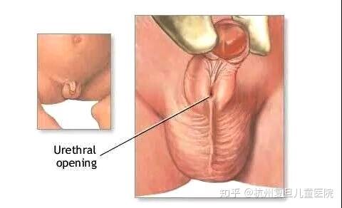 尿道下裂解析篇 一丁点小问题 知乎