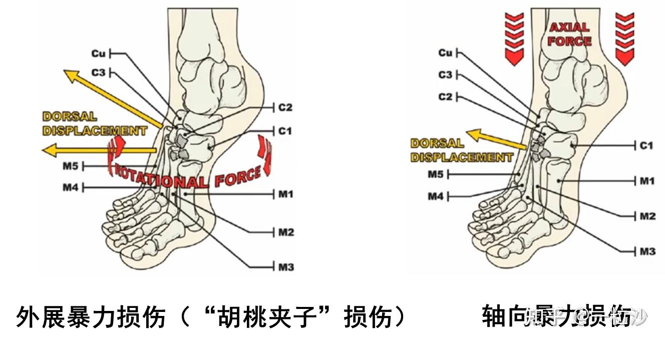injuries)即lisfranc 损伤,是指跖跗关节和楔间关节的骨质或韧带损伤