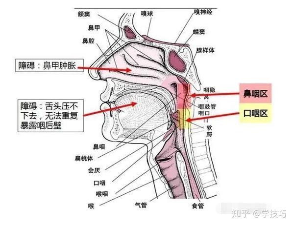 先看看咽拭子和鼻拭子的采样对比图:鼻拭子采样示意图:咽拭子采样示意