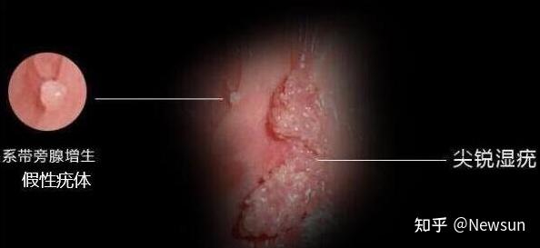 (内附图片) newsun 女阴假性湿疣是一种正常的生理变异,并非病态,也有