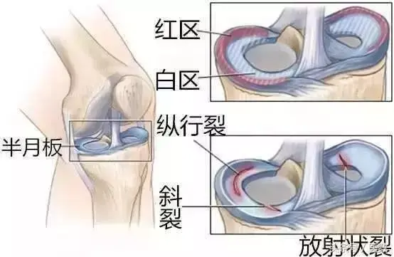 半月板损伤知多少 知乎