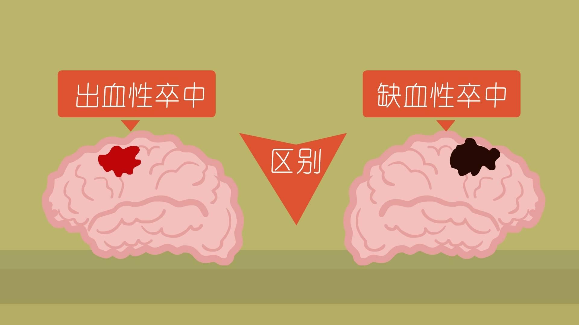 出血性卒中 zhuanlan.zhihu.com