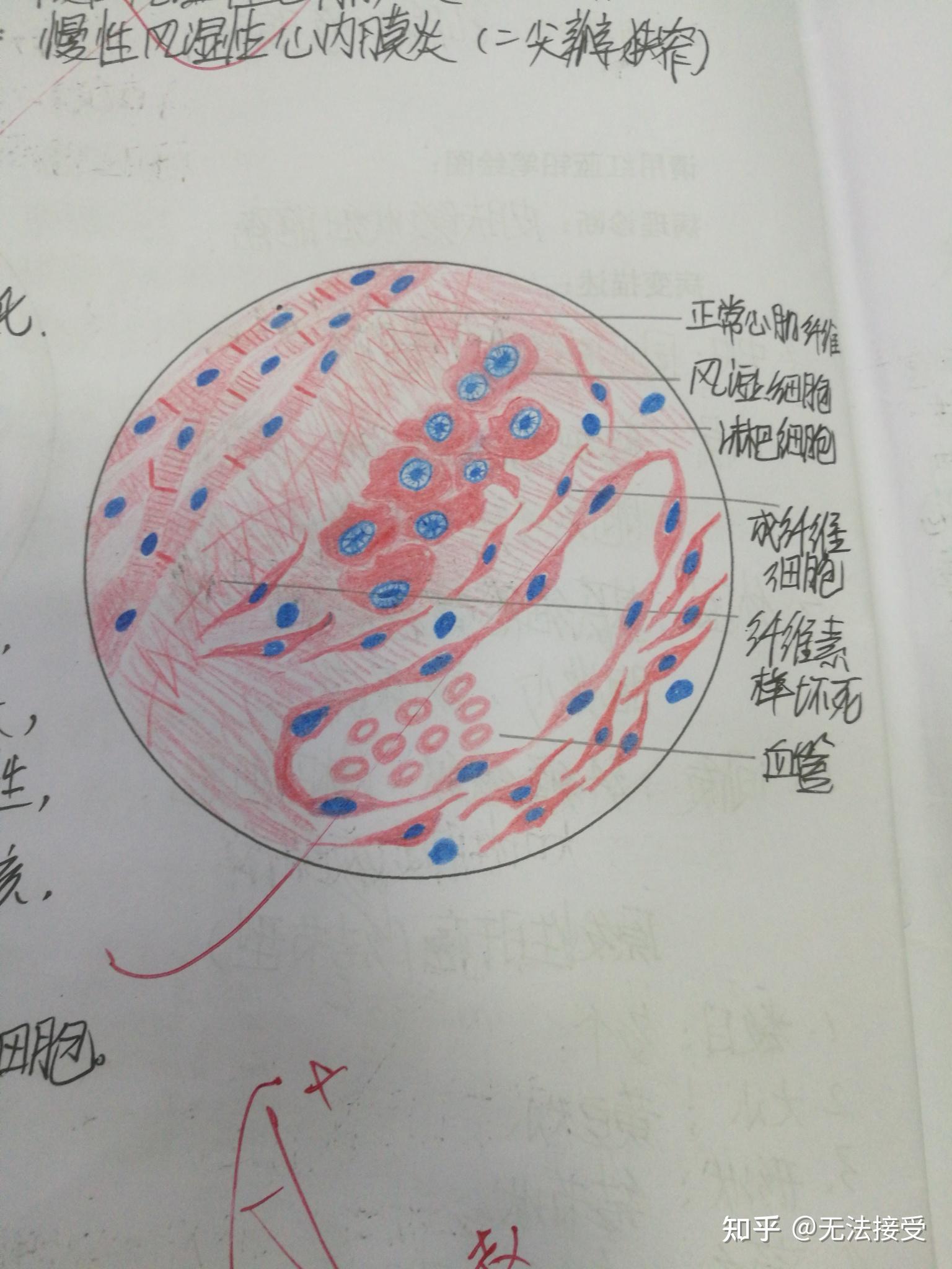 大叶性肺炎门脉性肝硬化慢性硬化性肾小球肾炎结核结节