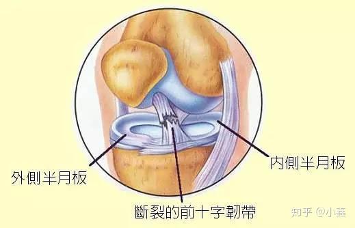 咔嚓,膝蓋傷了?咔嚓,韌帶斷了?咔嚓,半月板撕裂了? - 知乎