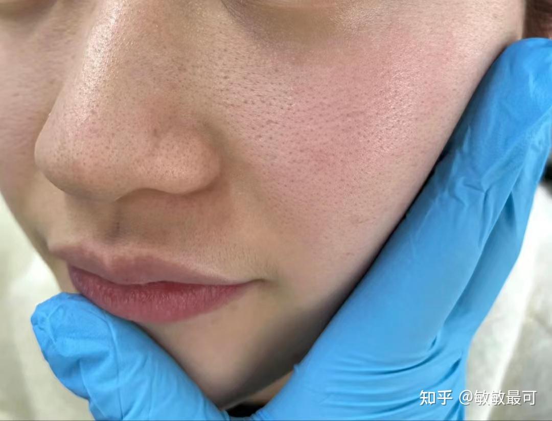 鼻子黑头好多怎么办啊,我这10多年的草莓鼻外加粗大毛孔是不是没救了?