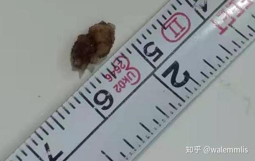 输尿管结石9x5mm,一周排出