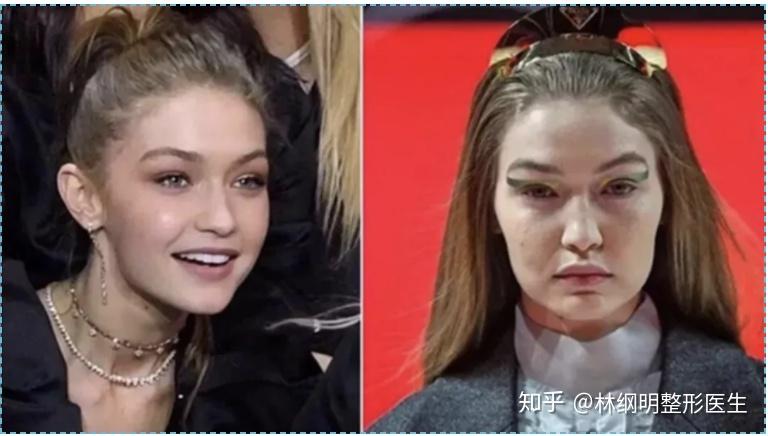 【林医生美学课堂】小脸变方脸,90%的人都是发腮了