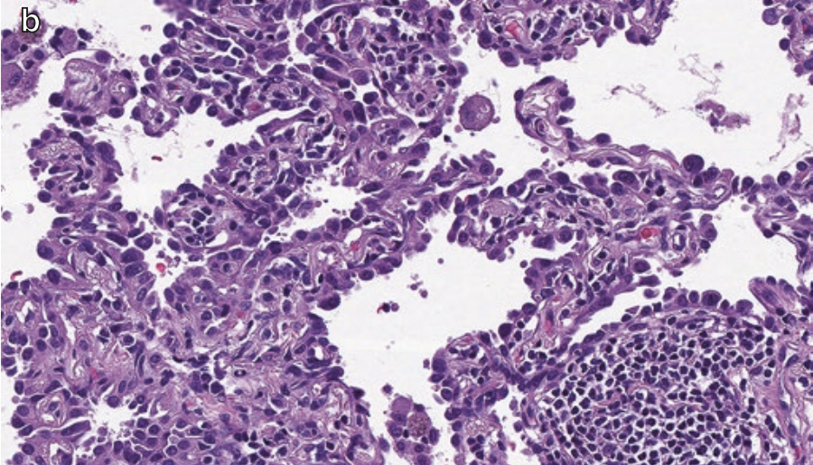 呼吸病理学:肺癌其一-概述 肺鳞癌 肺腺癌