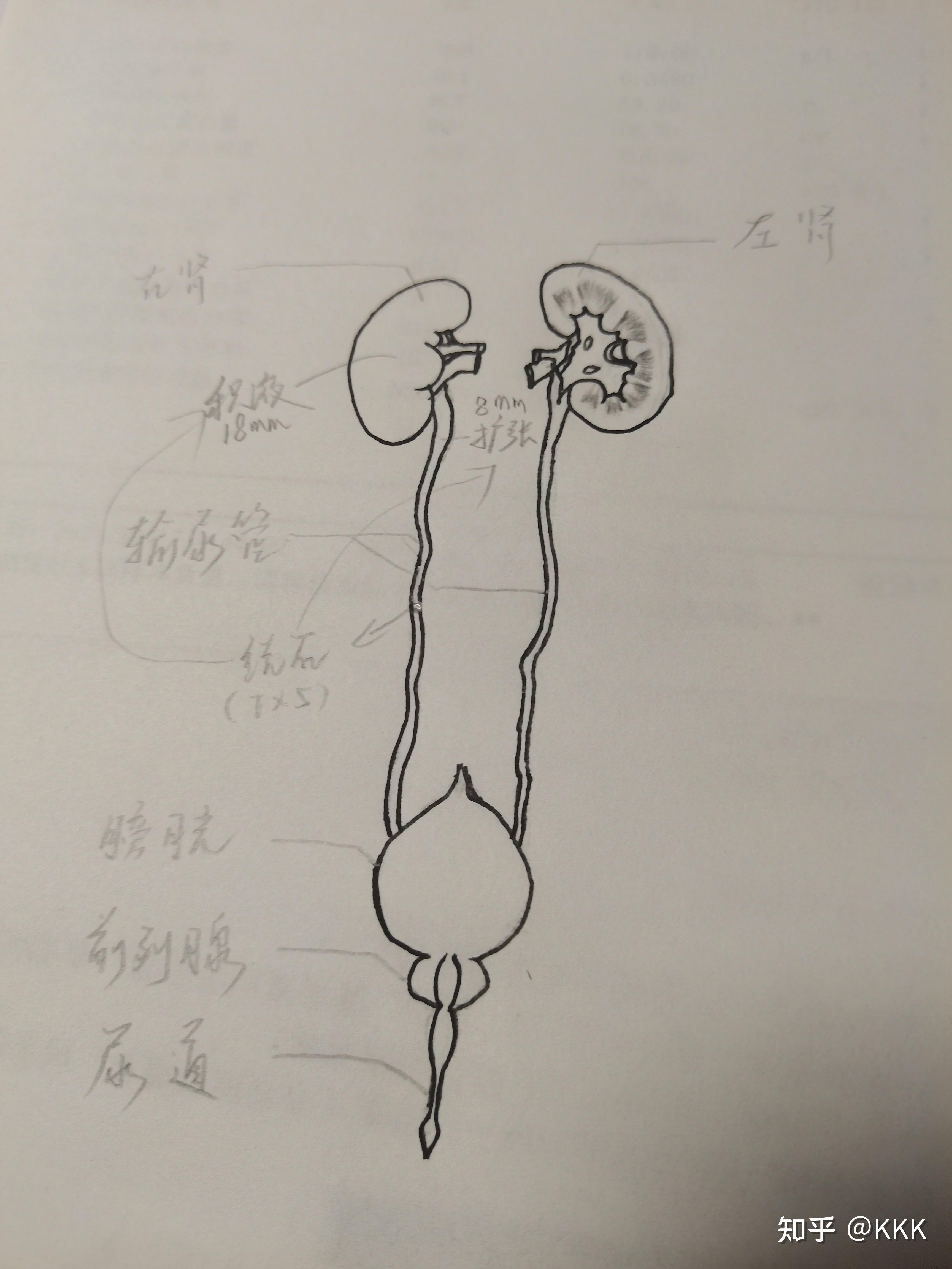 记录一次肾结石发作