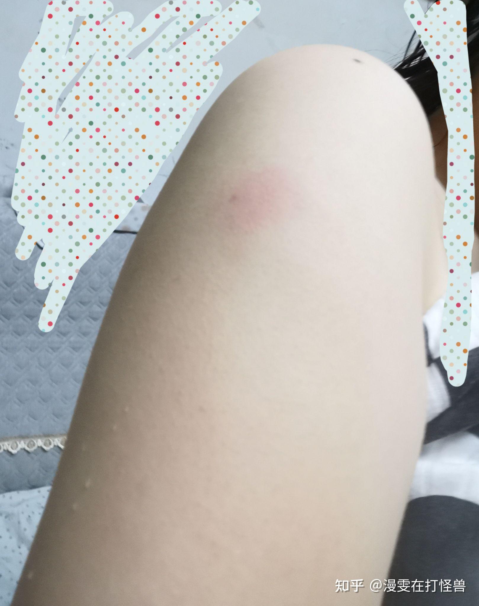 第三针新冠疫苗打完后打针的地方红肿痒3天都没好前两针都没任何副