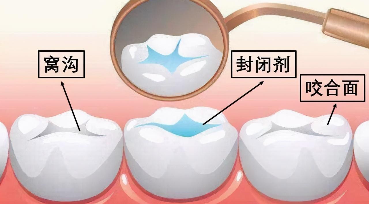 补牙,学名叫龋补充填,就是把牙齿中龋坏的部位清理干净,再补进去不被