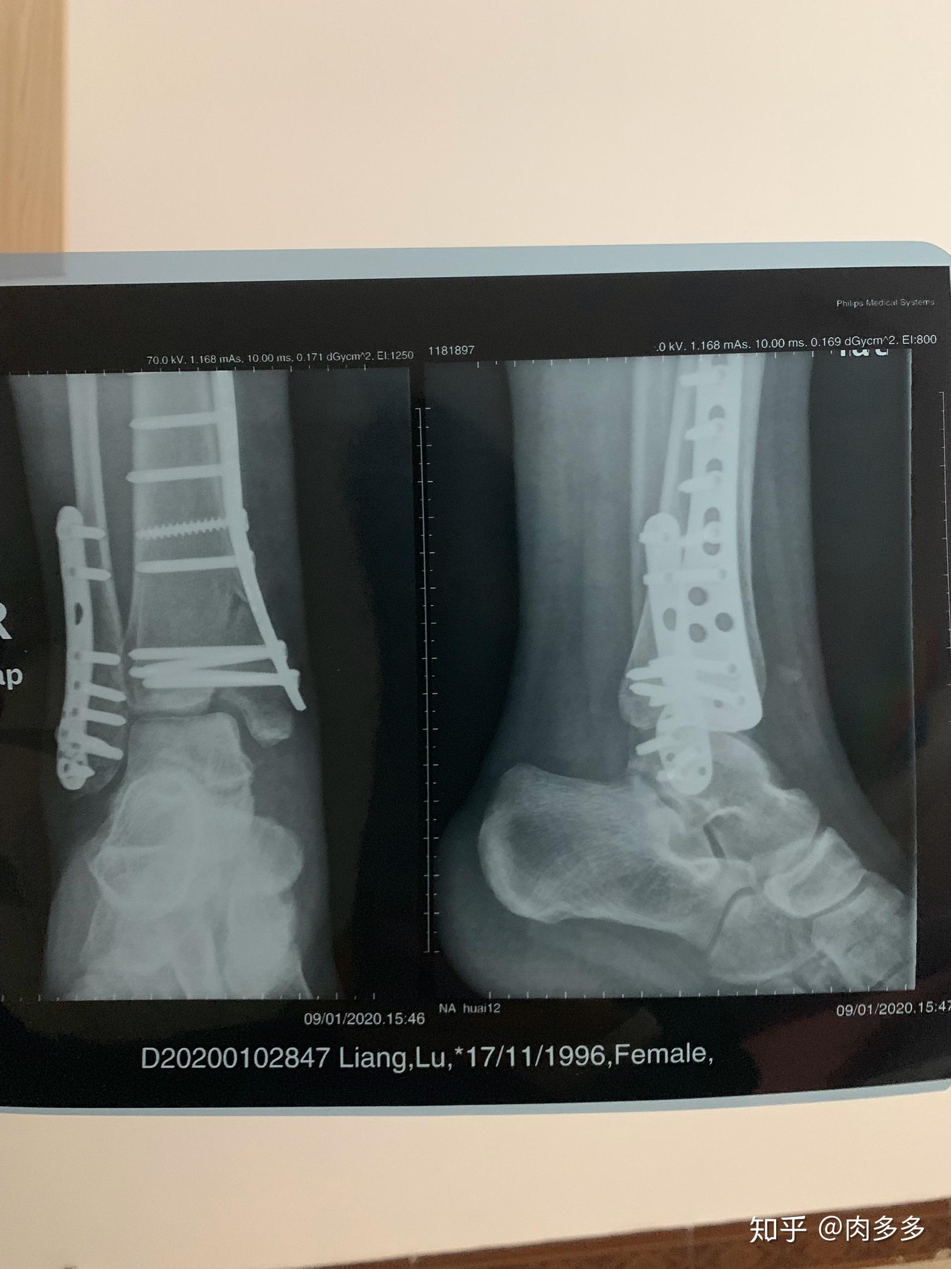 踝关节骨折病例 - 骨科专业讨论版 -丁香园论坛