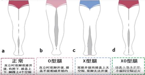 怎样纠正x型腿 知乎