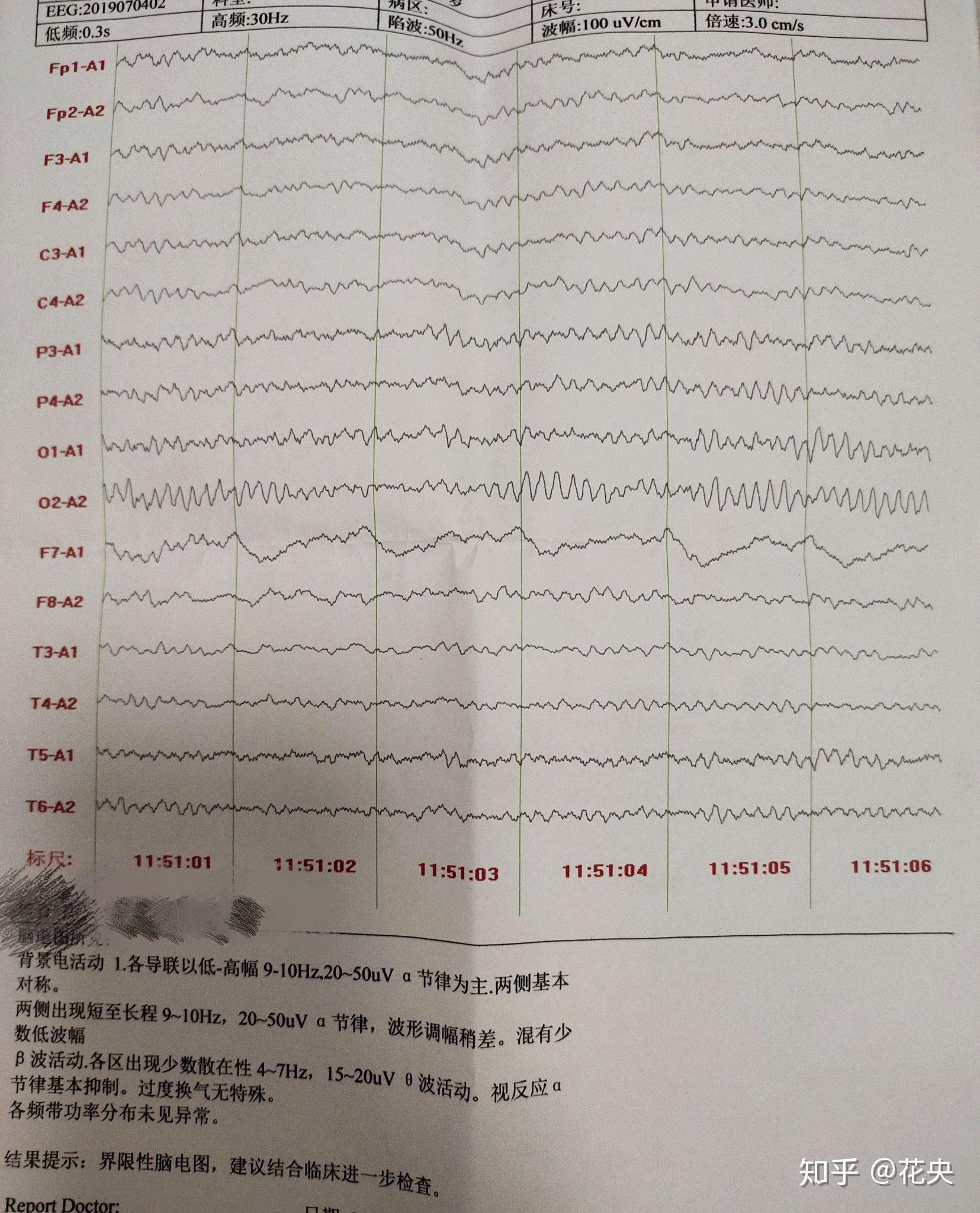 可以帮我看看这抑郁症脑电图吗谢谢谢谢谢谢