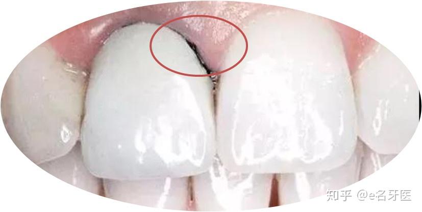 牙冠下方的牙根腐烂