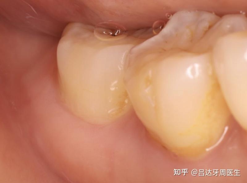 用牙线,真的会损伤牙龈吗?关键在方法