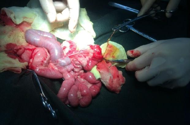 胃内切开,肠道切开取出鸡骨头血凝显示正常生化显示谷丙转氨酶升高