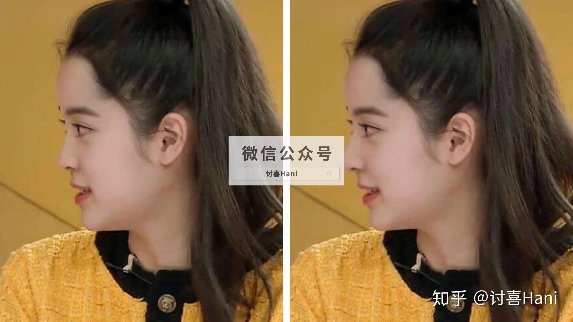 揭秘侧颜瘫脸型真相微凹面型和假凹面型了解一下