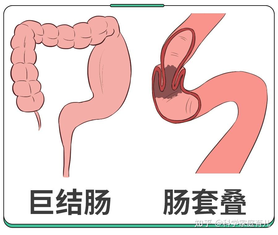肠道先天性畸形,炎症粘连,肿瘤,疝气,先天性巨结肠等也会引起肠梗阻