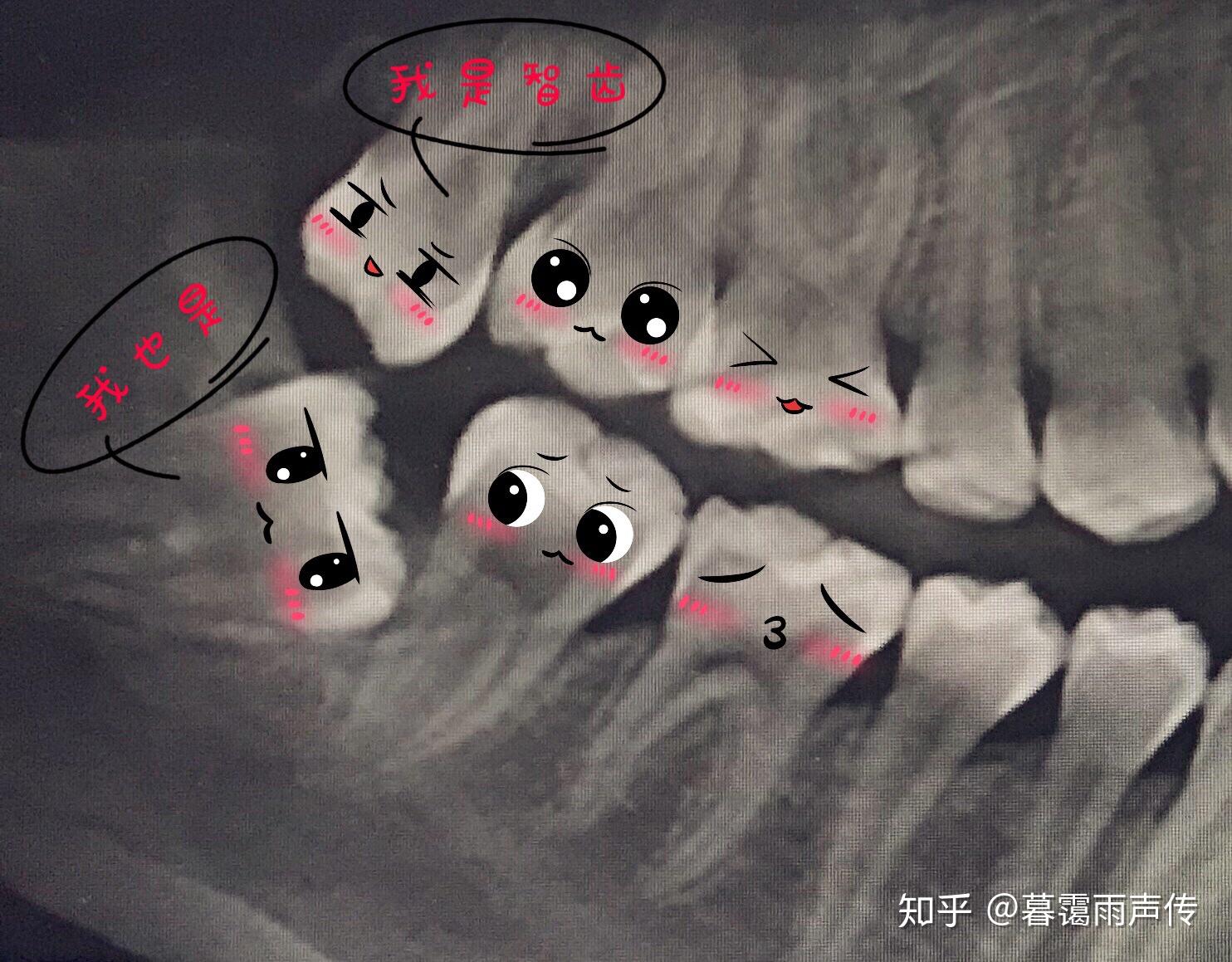 智齒也叫第三磨牙,磨牙是醫學上的專業術語,其實就是我們所熟知的後