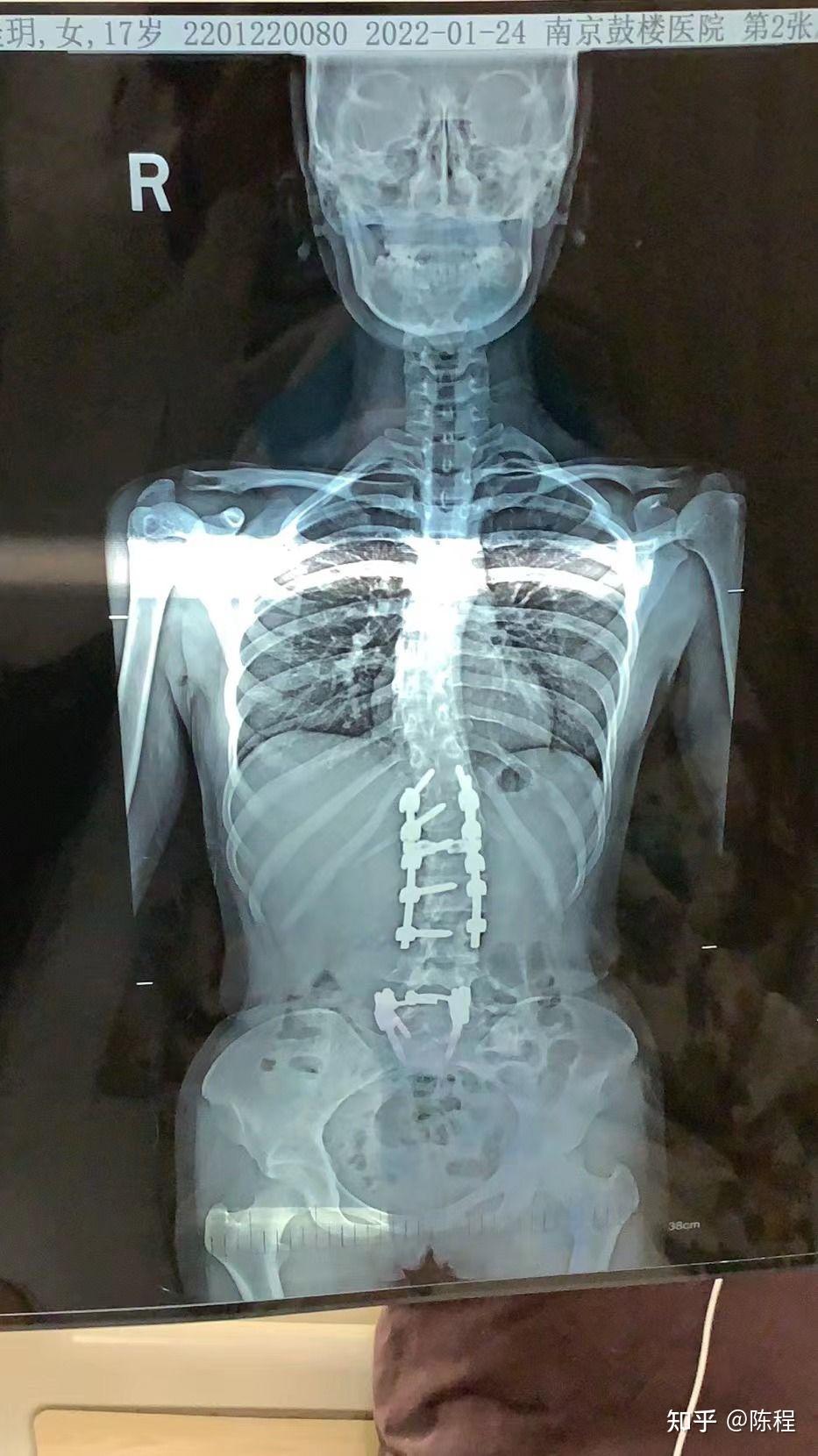 脊柱侧弯患者自述 手术过程记录 - 知乎