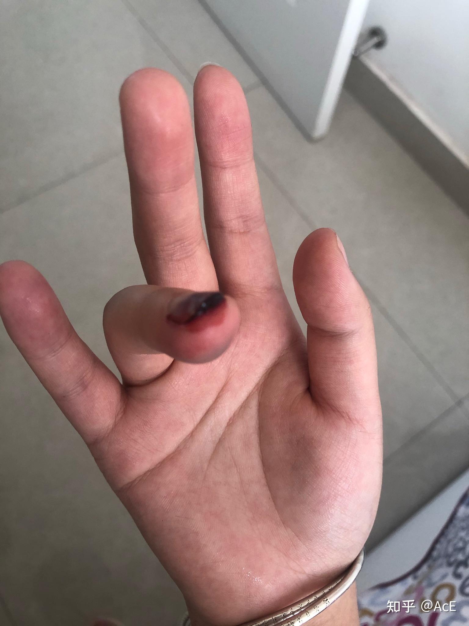 手指被15片包装好的地砖夹到