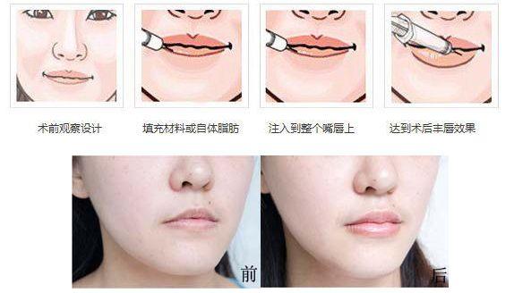 唇部整形│万千口红不敌两瓣美唇 - 知乎