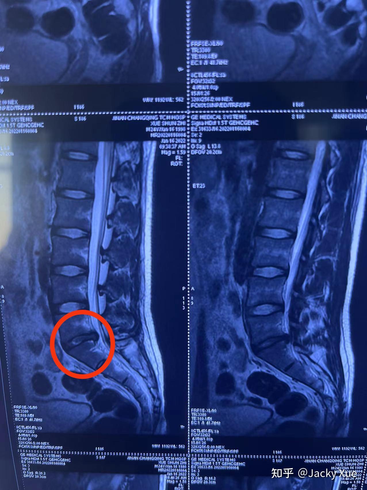 23岁l5s1腰椎间盘突出(脱出)引起脚麻的4个月记录
