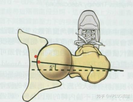 67再来看下股骨与骨盆的前倾角从后面看:骶骨 : 男性为等腰三角形
