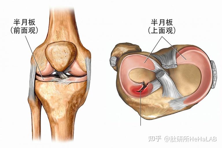 引起膝关节卡顿的原因有很多,常见原因是半月板撕裂和关节内游离体