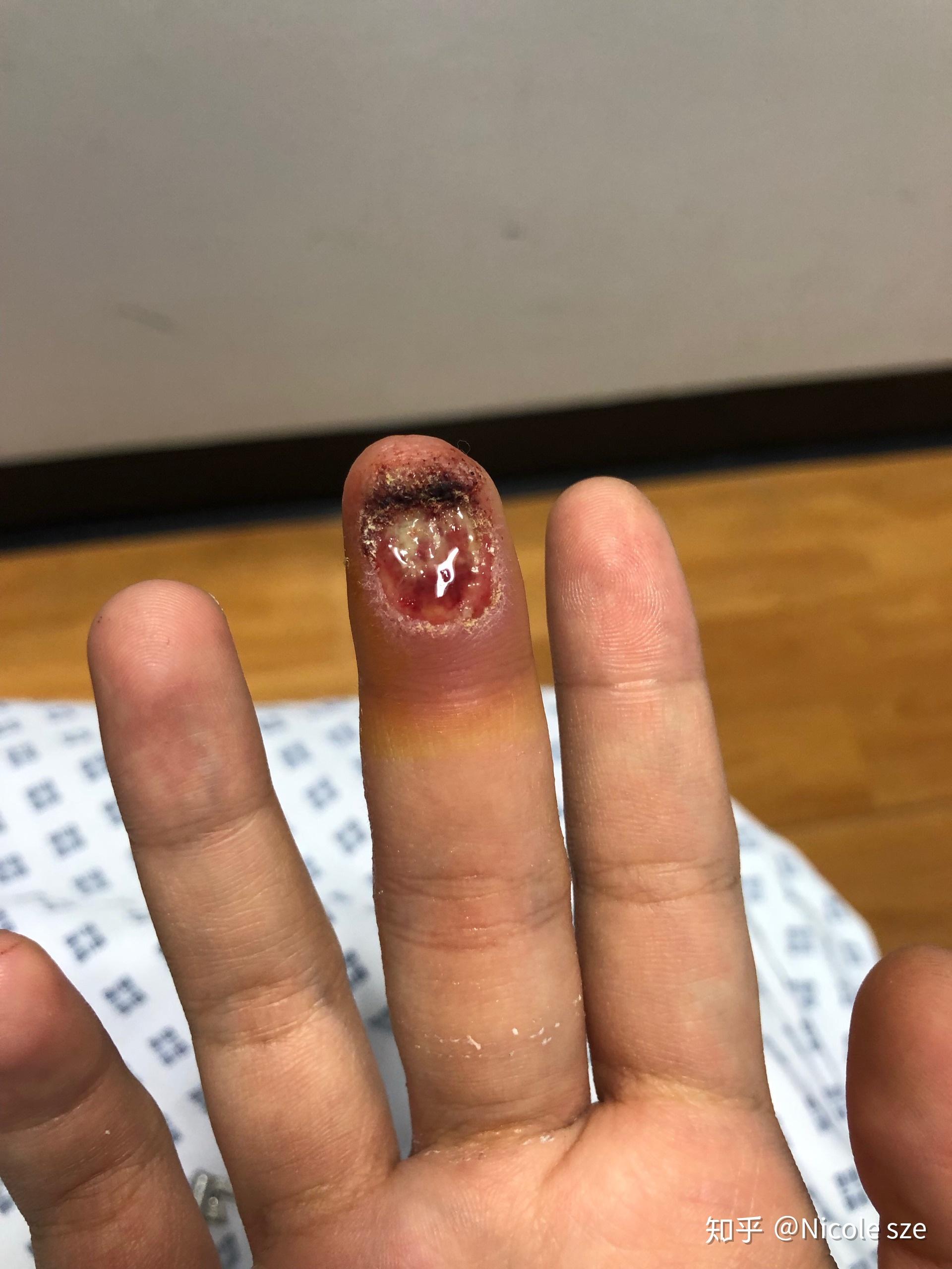 手指伤口化脓图片图片