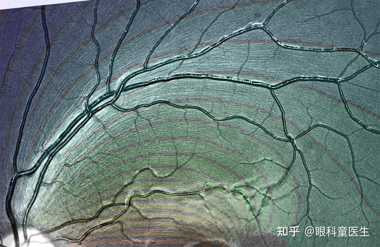 视网膜有髓神经纤维图片