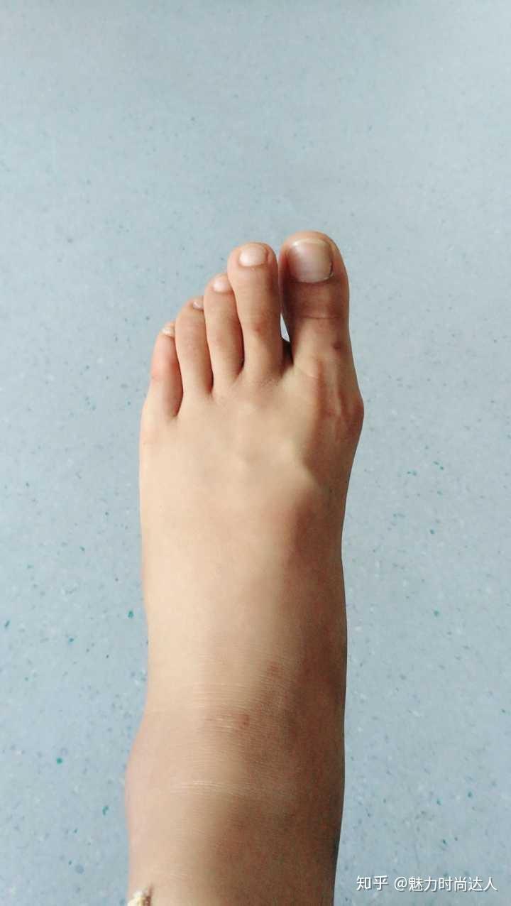 我的大腿吸脂给你们看看我的抽脂日记科普