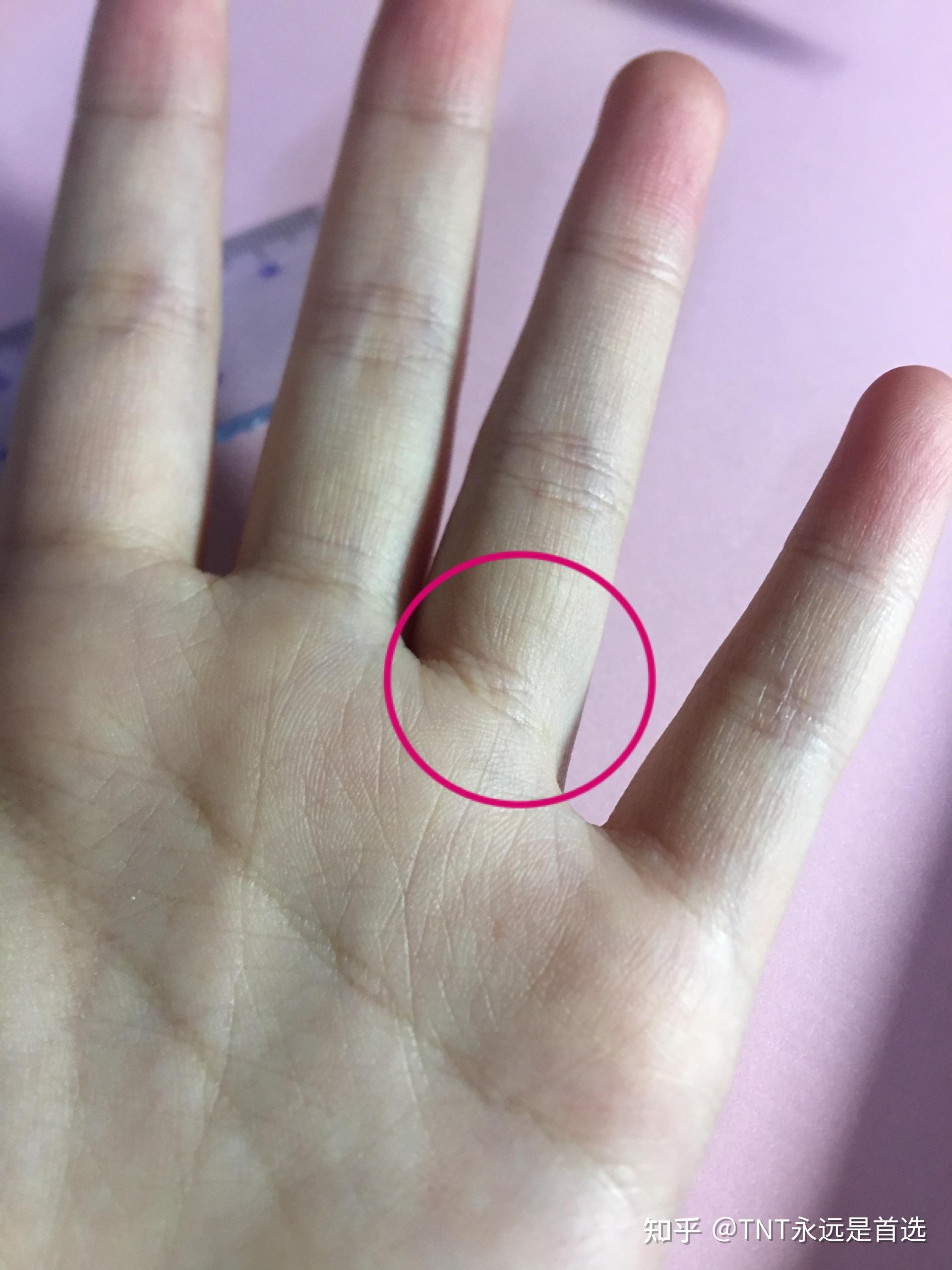 手指上有个地方凸起是什么情况摸着是骨头圆圆的一粒看不出来但是摸