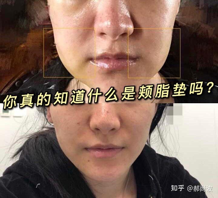 你真的知道什么是颊脂垫吗