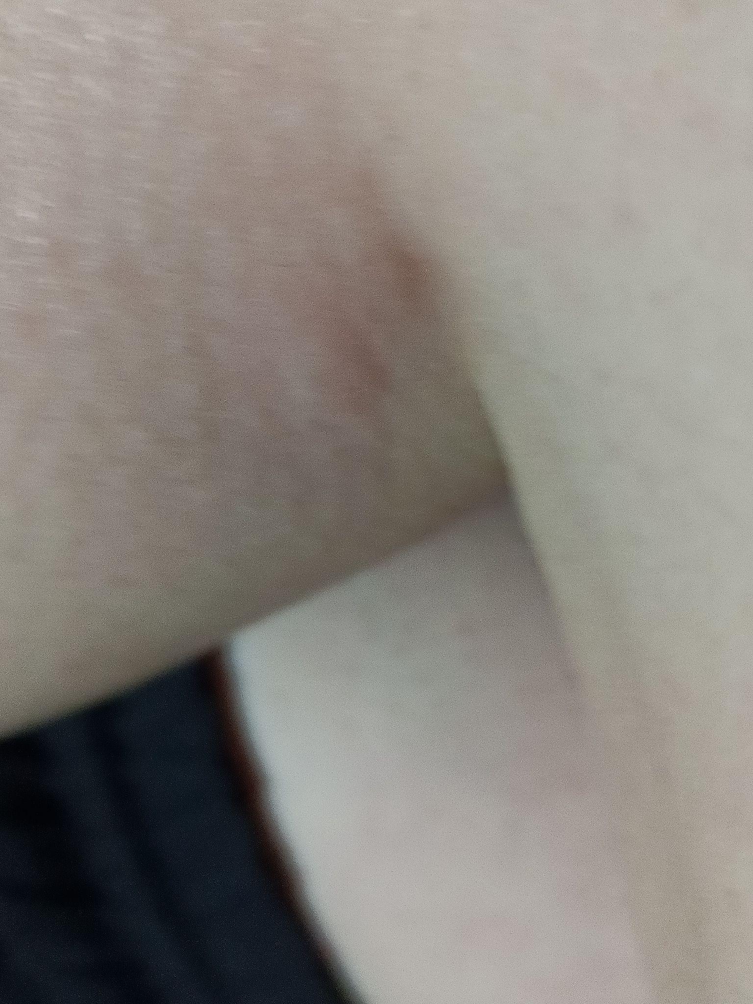 包含女性大腿内侧痒痒越抓越痒的词条 包罗
女性大腿内侧痒痒越抓越痒的词条（女性大腿内侧痒痒越抓越痒红肿） 女性