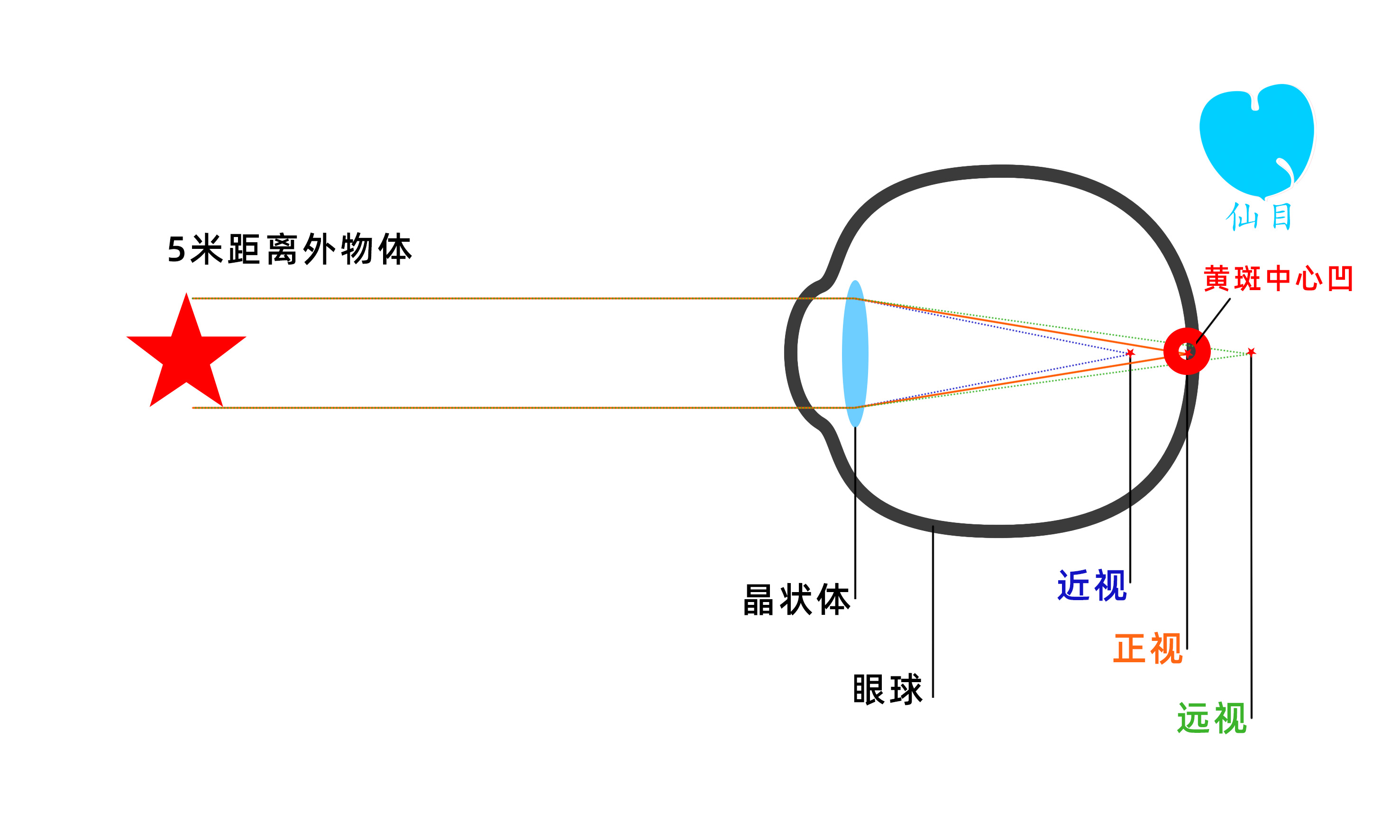 近视眼不会老花大错特错