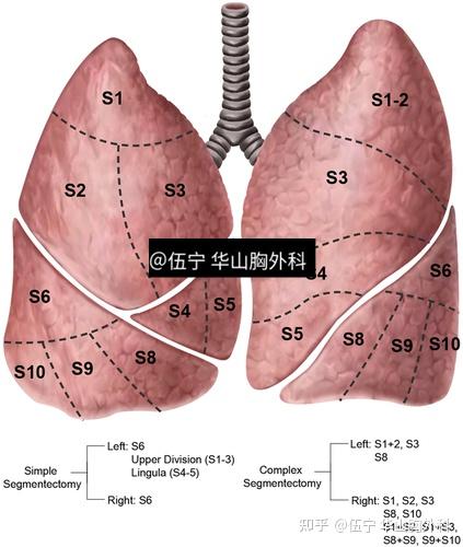 楔形切除肺段切除和肺叶切除三种手术方式的优缺点和应用
