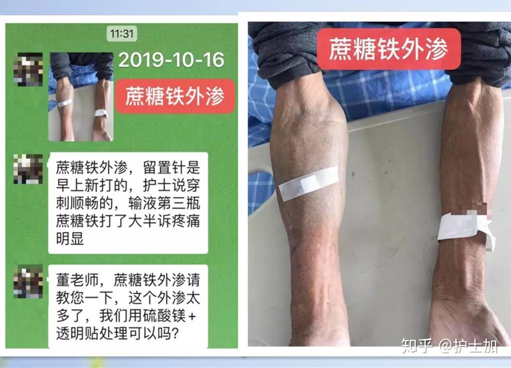 蔗糖铁外渗竟有如此严重下一步该怎么办