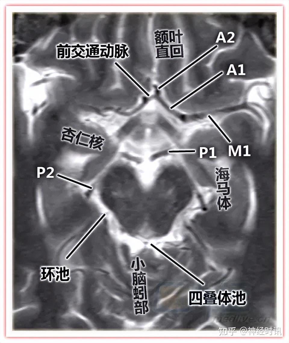 大脑willis环组成图片