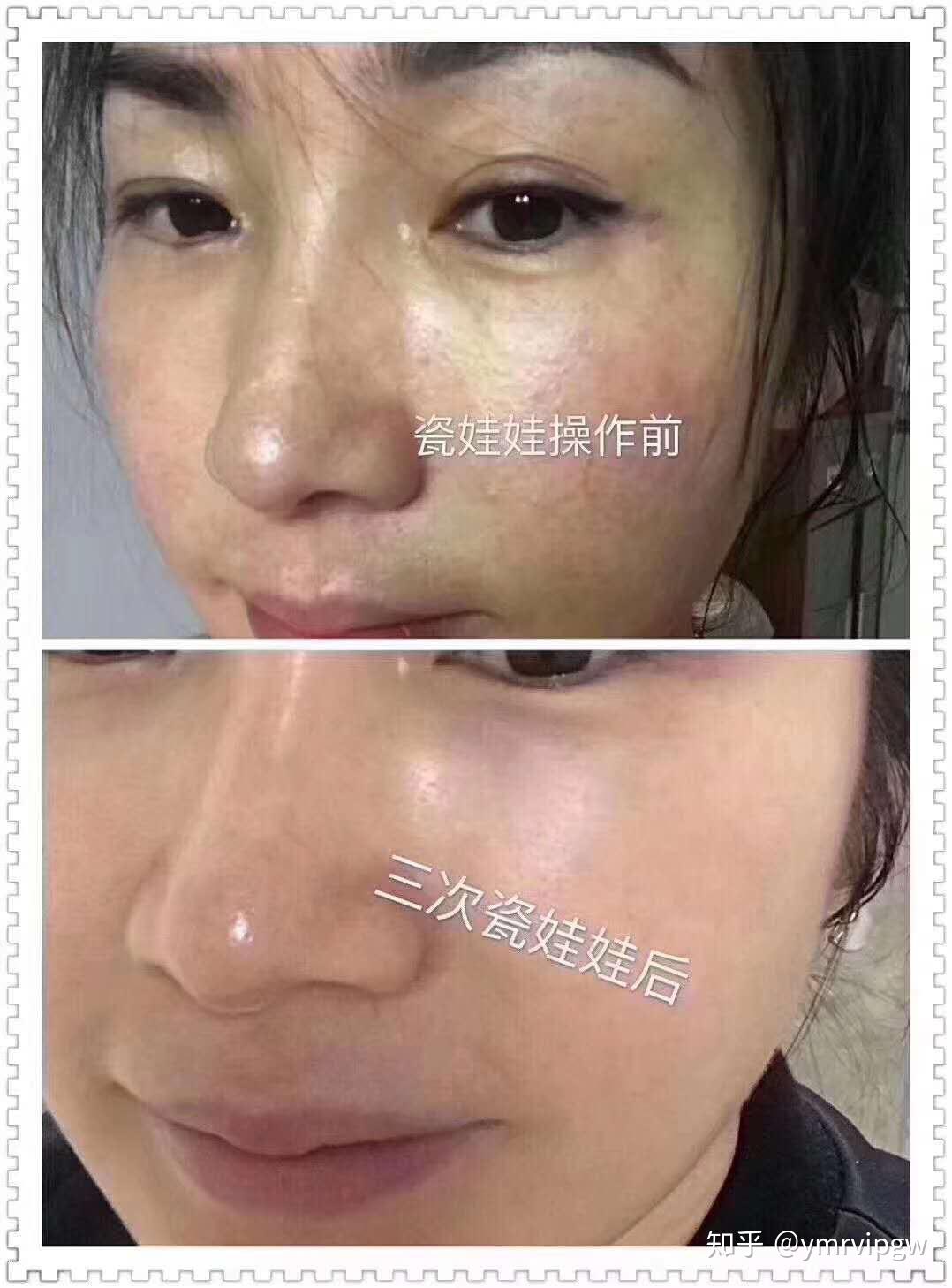 虞美人"瓷娃娃"案例清秀娃娃的重点在清秀两字,美白肌肤,更偏众于