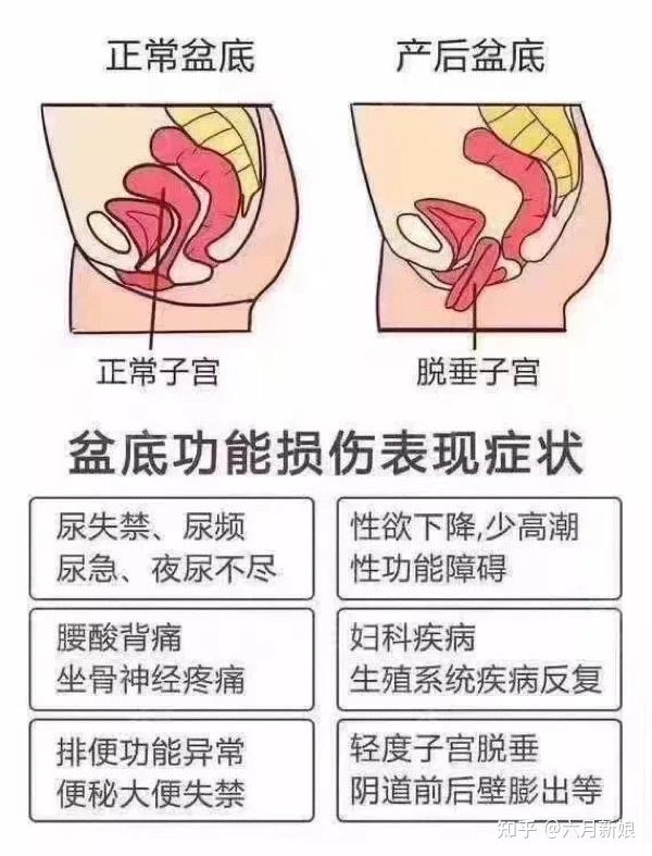 产后前壁膨出图真人图片