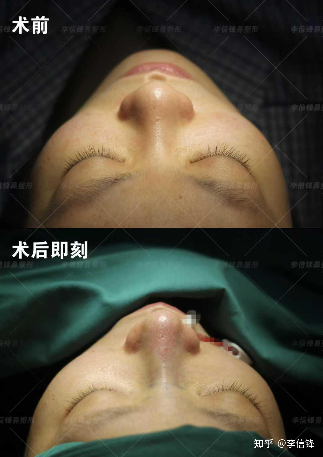 初鼻鼻综合-塌鼻梁、大鼻头改善案例,术后即刻对比~ - 知乎