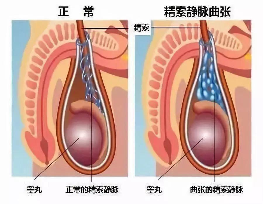 招飞体检 招乘体检 现役年度体检对精索静脉曲张若干问题的解释 下