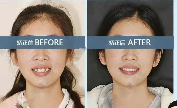 正畸小白必看牙齿矫正对颜值的改变大吗正畸需要花多少钱