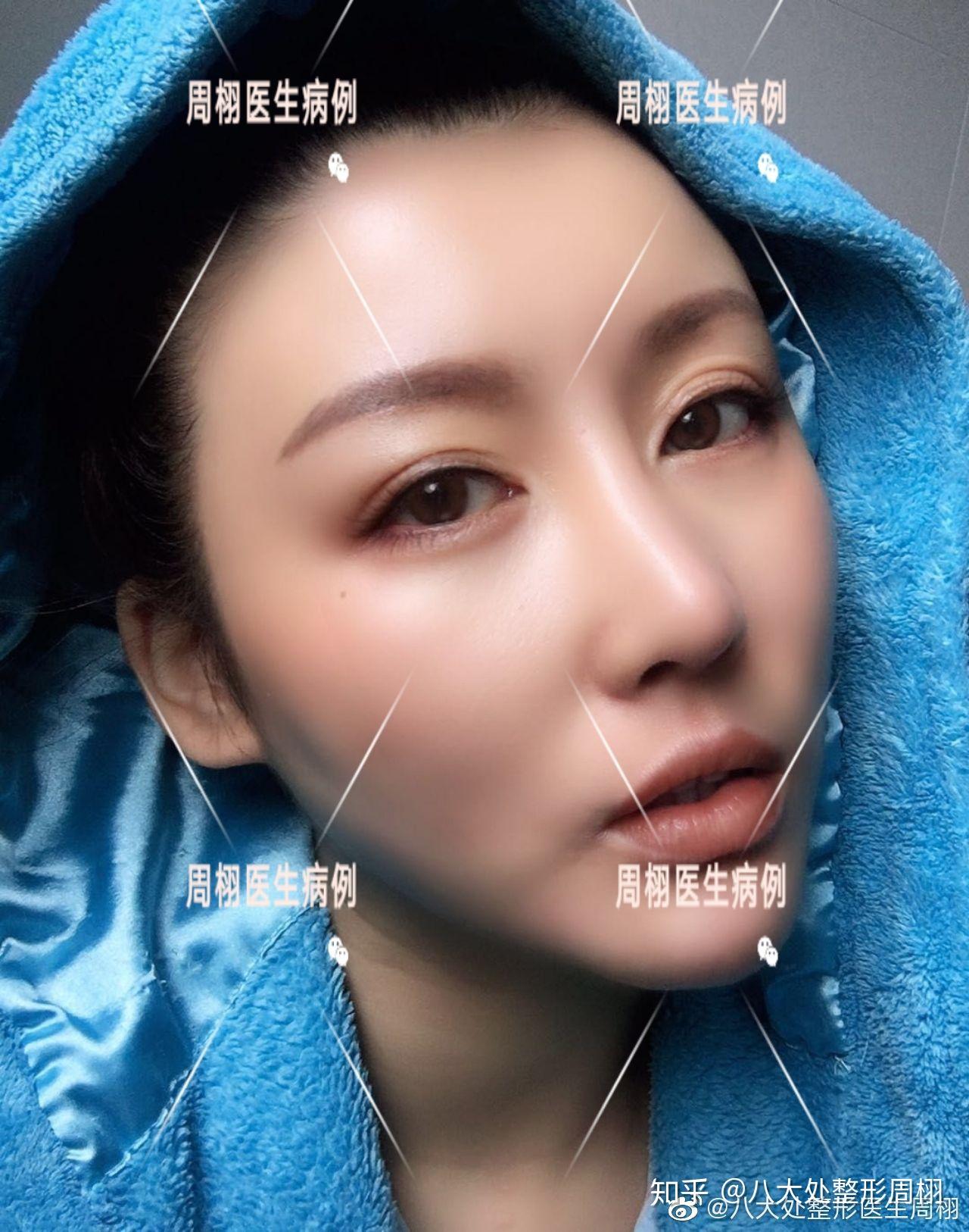 软肋骨隆鼻 - 知乎