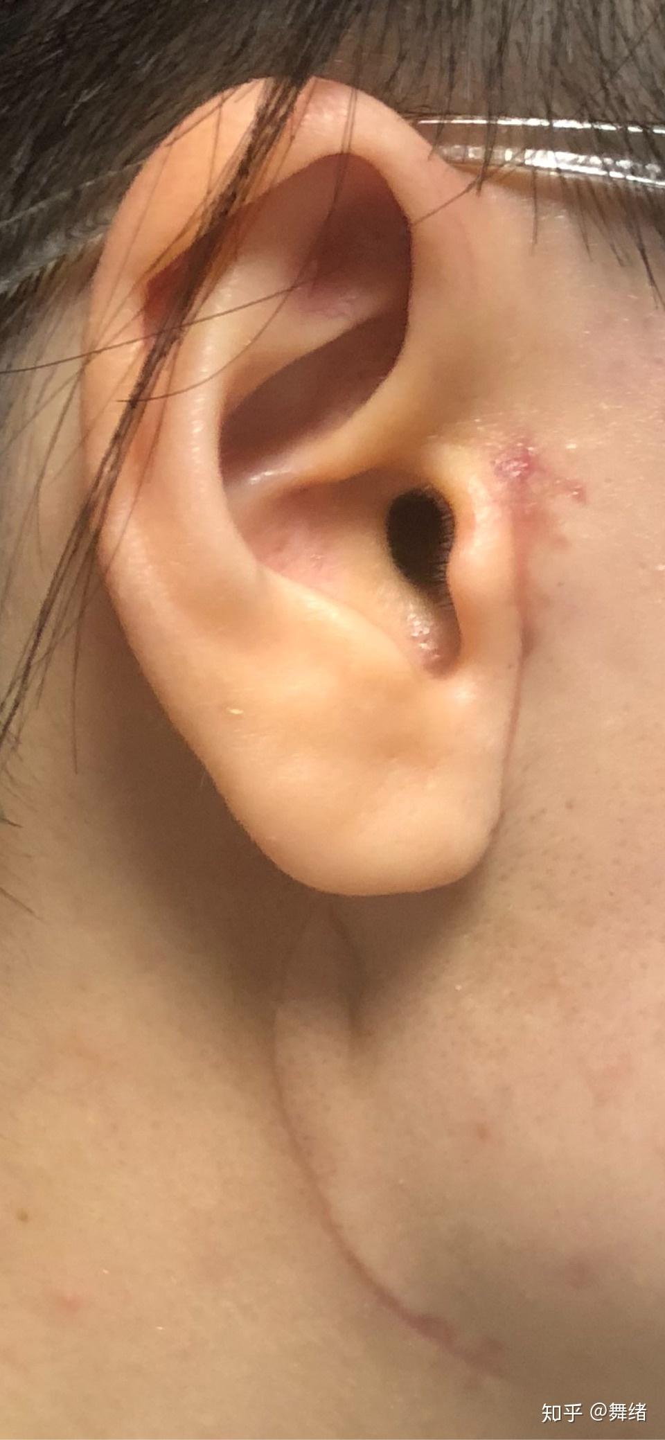 腮腺混合瘤康复篇