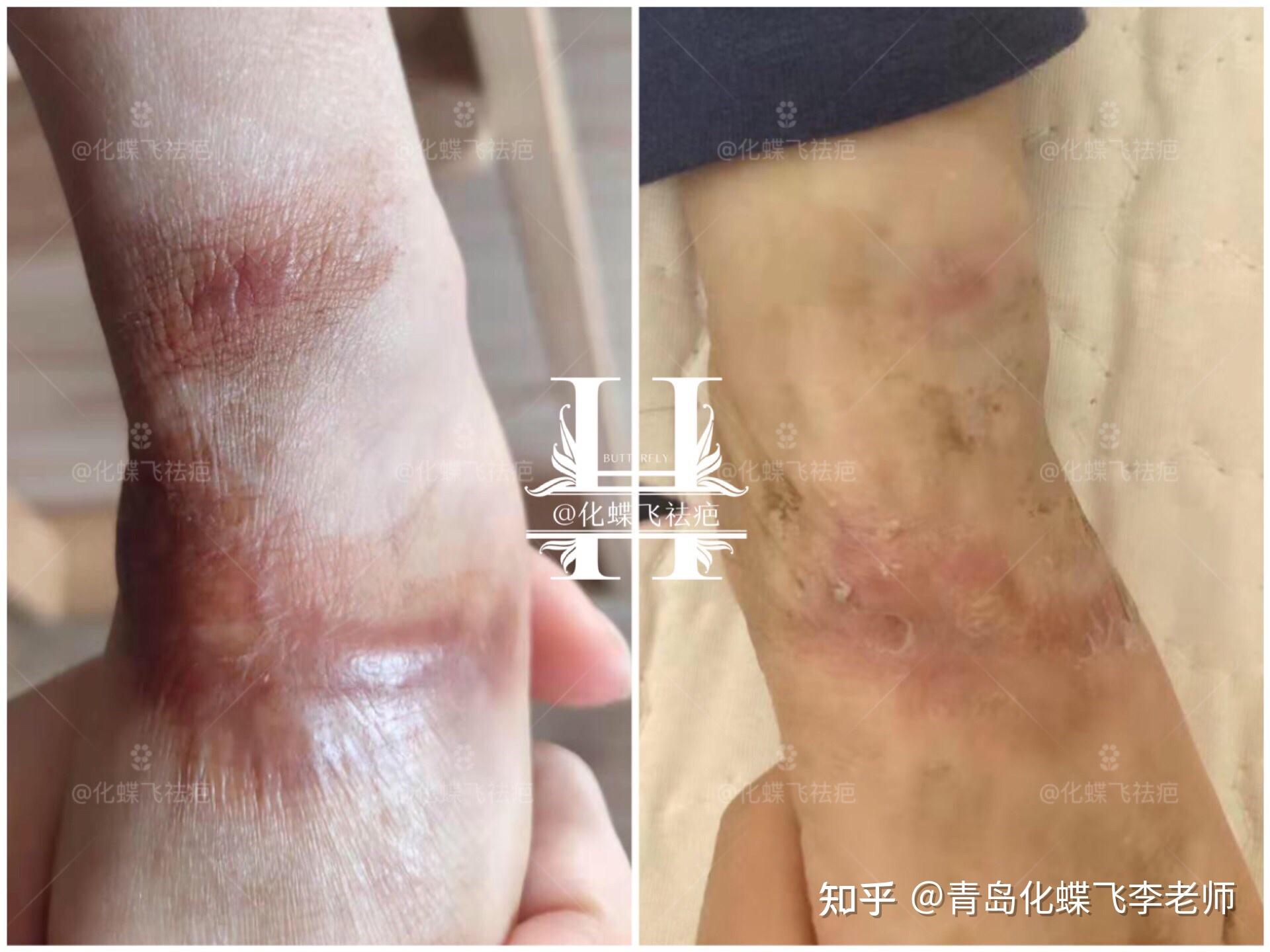 增生薄了,颜色淡了,脚腕还有些硬,继续修复中……【宝宝烫伤疤痕】