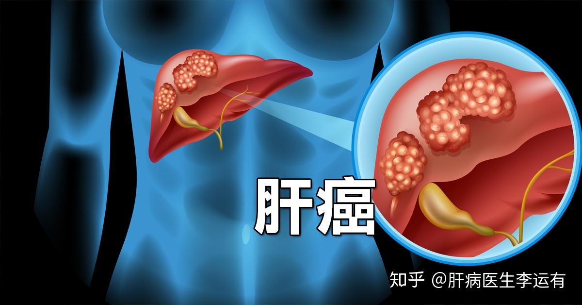6万/年,其中传染性肝炎病毒以及嗜酒导致的肝癌死亡是肝癌的高危因素.